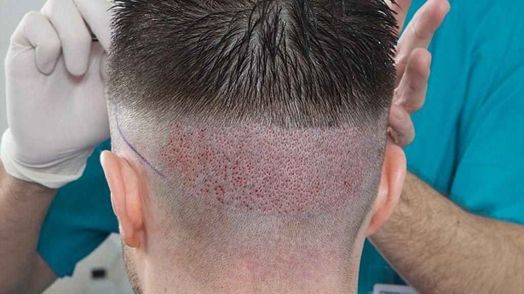 أفضل مراكز زراعة الشعر في الشارقة